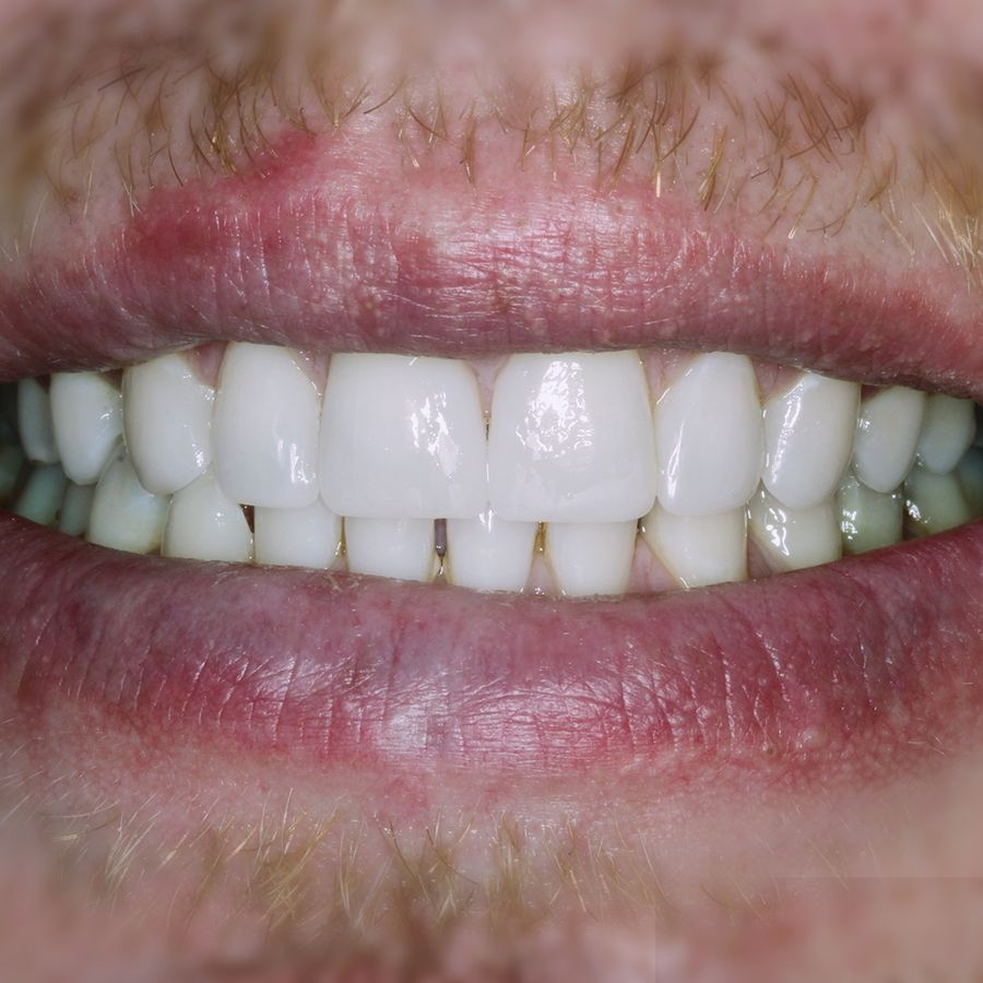 dental bonding - smile 1 - after - 3Dental